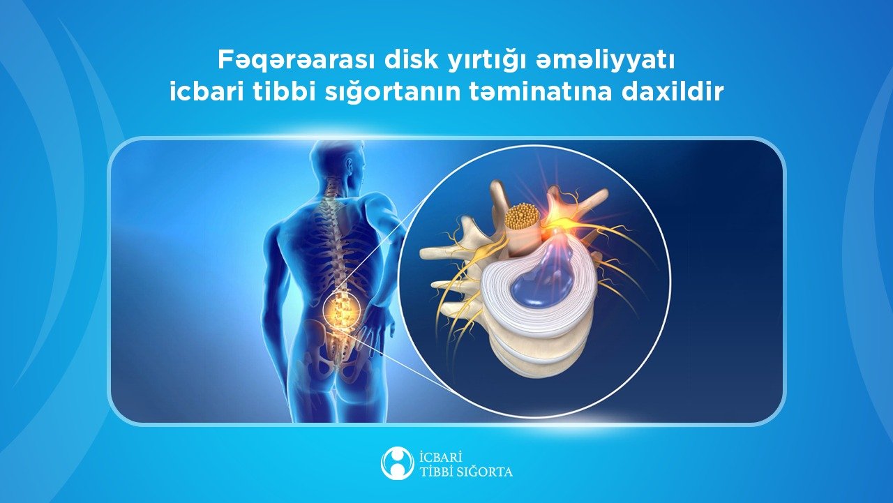 Fəqərəarası disk yırtığı əməliyyatı icbari tibbi sığortanın təminatına daxildir