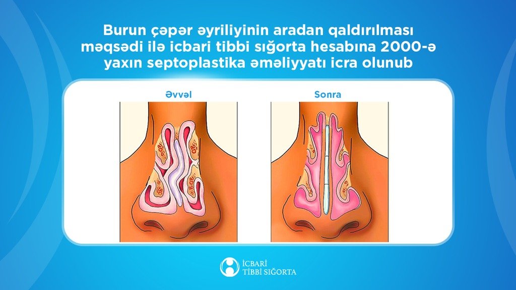 İcbari tibbi sığorta ilə 2000-ə yaxın burun çəpəri əməliyyatı icra olunub