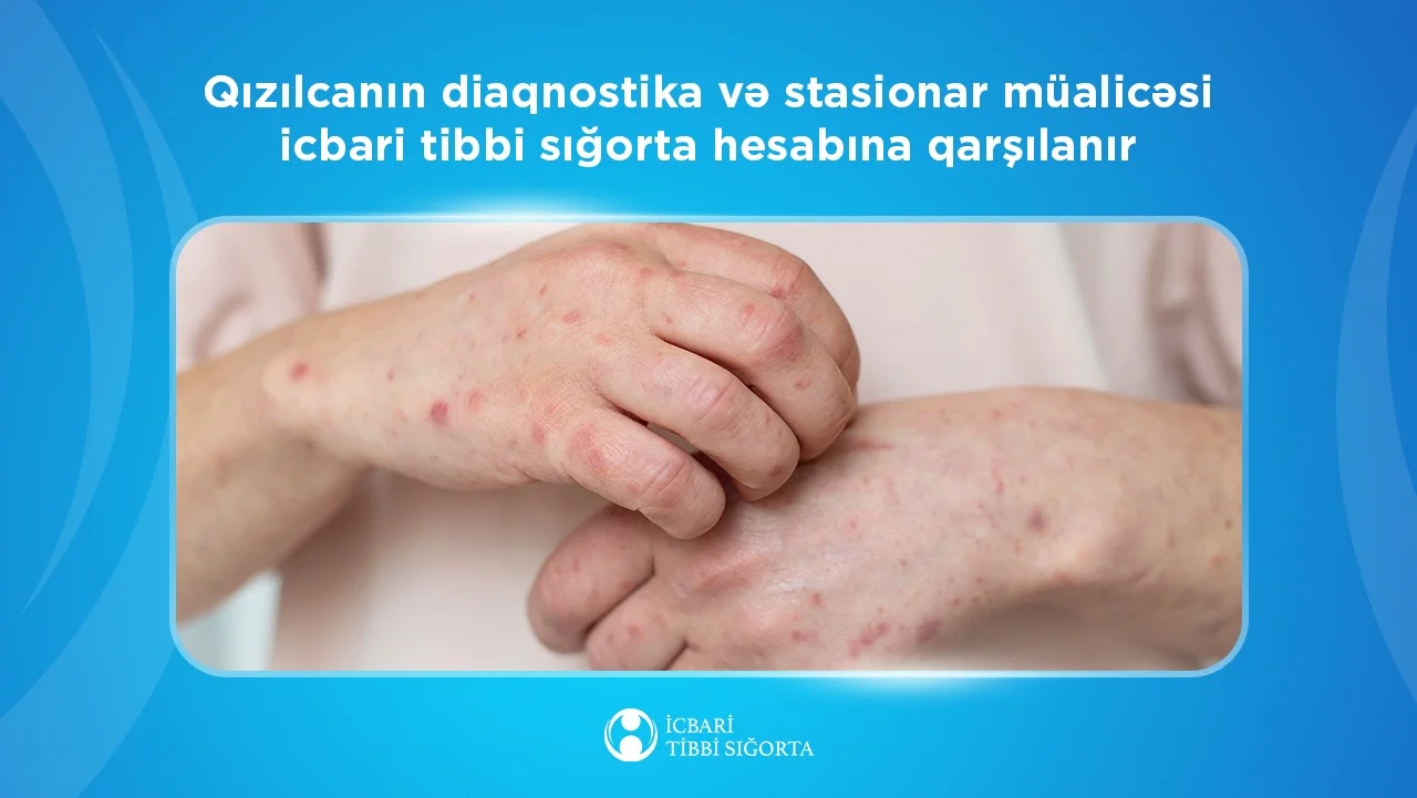 Qızılcanın diaqnostika və stasionar müalicəsi icbari tibbi sığorta hesabına qarşılanır