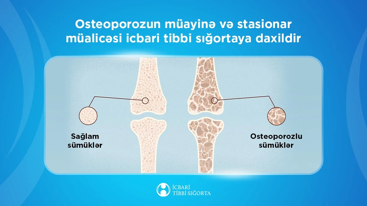 Osteoporozun müayinə və stasionar müalicəsi icbari tibbi sığortaya daxildir