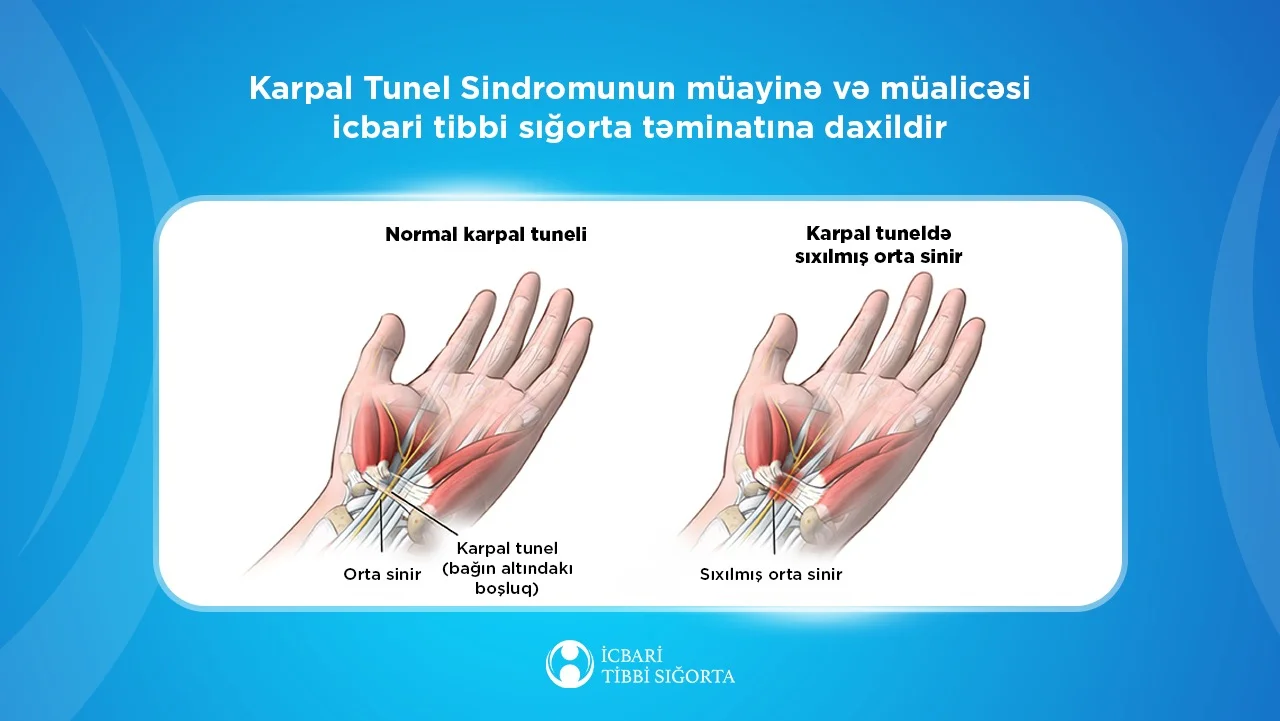 Karpal Tunel Sindromunun müayinə və müalicəsi icbari tibbi sığorta təminatına daxildir