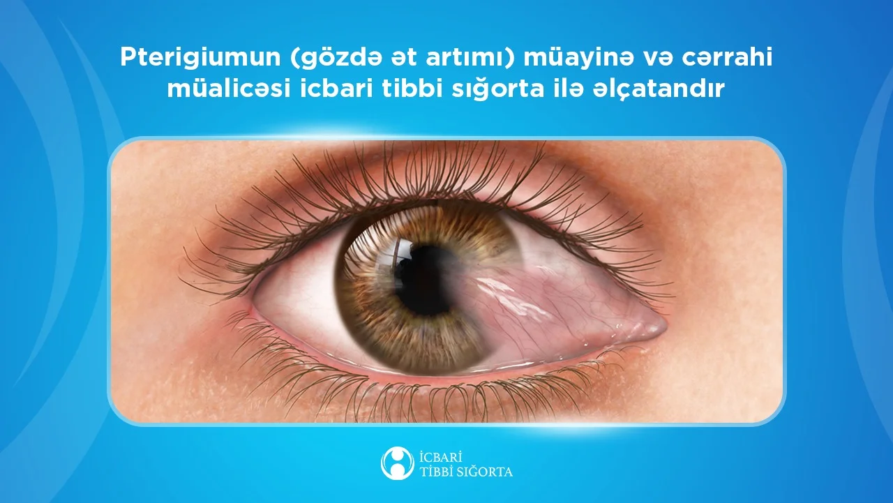 Pterigiumun (gözdə ət artımı) müayinə və cərrahi müalicəsi icbari tibbi sığorta ilə əlçatandır