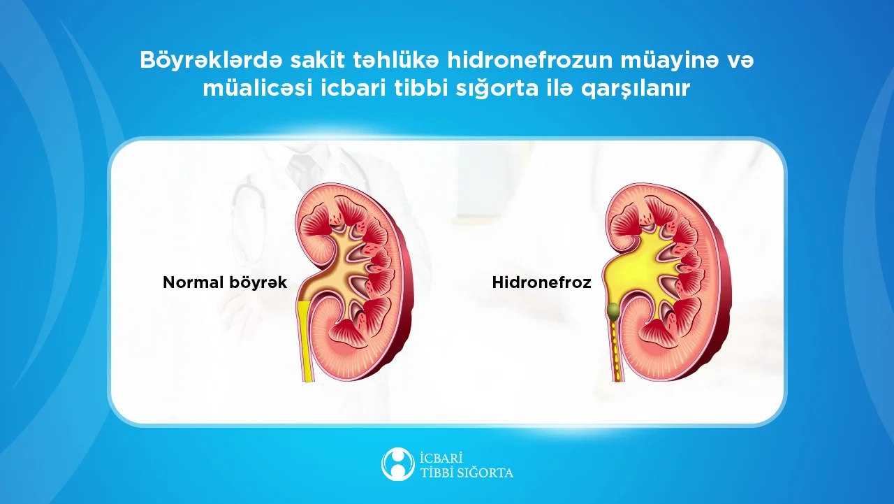 Böyrəklərdə sakit təhlükə - hidronefrozun müayinə və müalicəsi icbari tibbi sığorta ilə qarşılanır